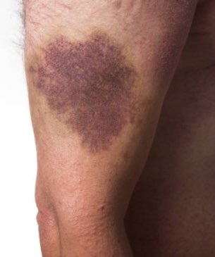 Image of an arm bleed.